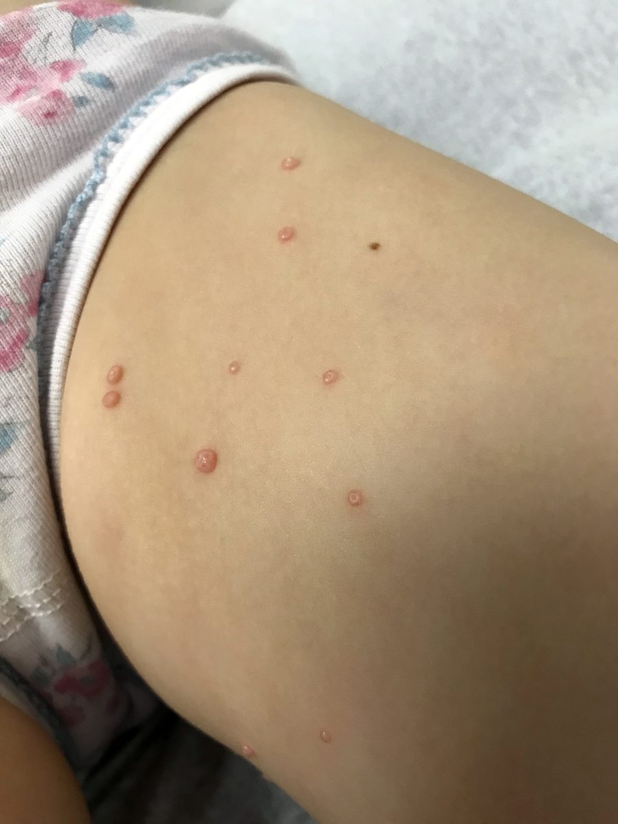 molusco contagioso